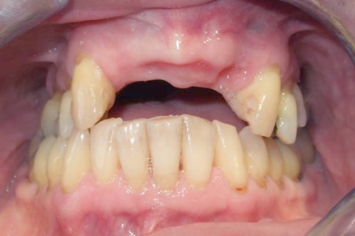 Visiclear Partial Dentures Chesterton IN 46304